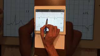 12 preexcitation syndrome example [upl. by Perceval]