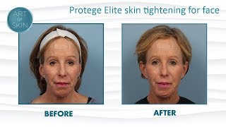 Protege Elite Radiofrequency for Skin Tightening [upl. by Joel]