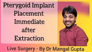 Placement of Pterygoid Implant in 2nd quadrant Live Surgery  BY DR MANGAL GUPTA dentistoncamera [upl. by Aicilaanna]