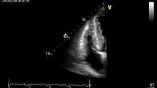 CARDIAC AMYLOIDOSIS  ECHOCARDIOGRAPHY cardiac ultrasound [upl. by Annovoj]