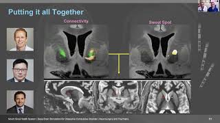 Deep Brain Stimulation DBS for ObsessiveCompulsive Disorder OCD [upl. by Rasia744]