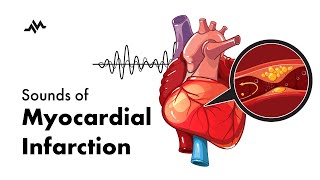 Sounds of Myocardial Infarction [upl. by Sanger443]