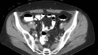 cecal diverticulitis [upl. by Patnode]