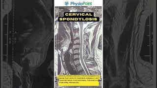 drshikhar physiotherapy MPT kasganj how to read cervical spondylosis mri no7500603832 [upl. by Lodie]