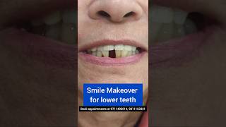 BEAUTIFUL Smile Makeover for Lower Teeth Dr Srishti Bhatia smilemakeover smile teeth [upl. by Weatherley]