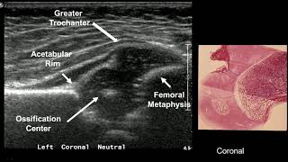 Imaging in developmental hip dysplasia [upl. by Yerkovich939]