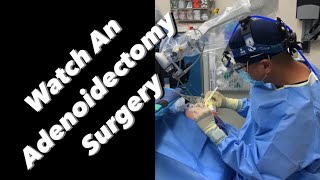 Adenoidectomy  actual footage [upl. by Ruelu567]