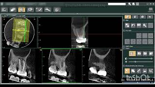 MISSED MB2 CANAL CBCT ENDODONTICS CASE REPORT [upl. by Airom]