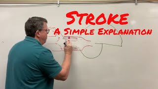 Stroke Cerebrovascular Accident A Simple Explanation [upl. by Ennovaj713]