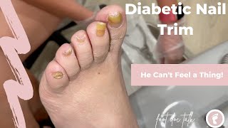 Diabetic Nail Trim [upl. by Bivins847]