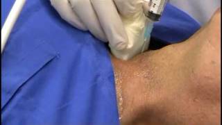 Agoaspirato Tiroideo  Fine Needle AgoBiopsy [upl. by Senn275]