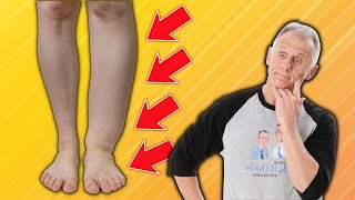 How To Fix Foot amp Ankle Swelling Everything You Need To Know [upl. by Irec671]