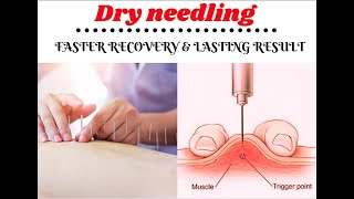 What Injuries Can Dry Needling Treat [upl. by Alegna]