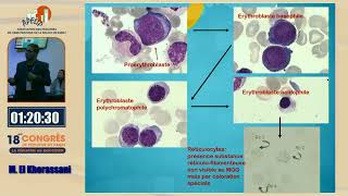 Atelier  Lecture de lhémogramme et la place du frottis sanguin M Khorassani [upl. by Ramej]