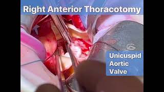 Right anterior thoracotomy AVR  Supracoronary Ao replacement [upl. by Laicram319]