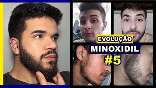 EVOLUÇÃO DE INSCRITOS  MINOXIDIL 5 [upl. by Watt]