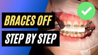 BRACES OFF  Step by step orthodontic removal [upl. by Osnerol]