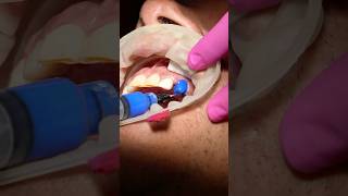 Crown Placement DentalCrown DentalCare SmileMakeOver Veneers Cancun DentalTourism [upl. by Dace773]