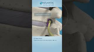 Lumbar Lateral Stenosis Shorts ​Atlantic Spine Center [upl. by Neetsuj]