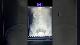 Intra venous urogram  pyelogram  radiological xray medicalimaging doctor anatomy [upl. by Ainoloppa]