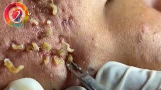 Ultimate Pimple Popping 2024 Satisfying Blackhead Extractions amp Acne Solutions [upl. by Nuahc]