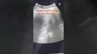 Hepatic hydatid cyst in the Right Lobe of Liver [upl. by Kalfas113]