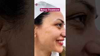 Wrinkles around the eyes  Botox Treatment for Face  Best Skin Clinic in Noida [upl. by Durrace]