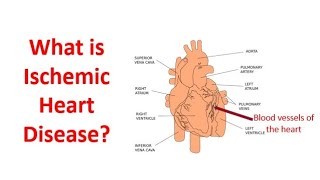 What is ischemic heart disease [upl. by Carmelina146]