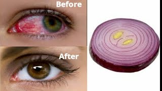 How to improve your eyesight naturally in 3 days how to correct bad eyesight fast [upl. by Chui200]