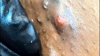 Blackhead and ingrown hair extractions pt2 [upl. by Aehtorod355]