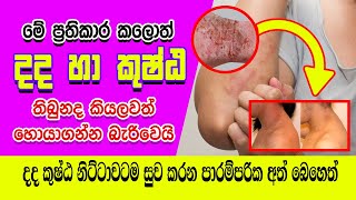 දද කුෂ්ඨ සදහා පාරම්පරික හෙළ සත්කාර  Treatments for Eczema sinhala [upl. by Ordisi372]