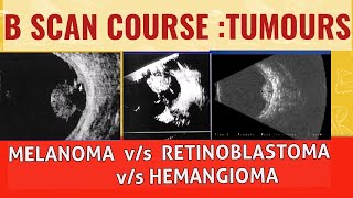 Bscan course  Differentiating choroidal melanoma from retinoblastoma and choroidal hemangioma [upl. by Llerej]