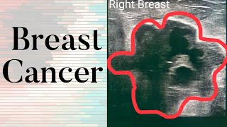 Breast Cancer  What Does Breast Cancer Look Like on an Ultrasound [upl. by Haslett]