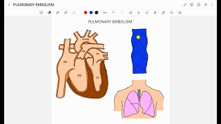 PULMONARY EMBOLISM [upl. by Nelyak]