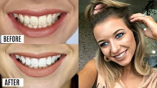 HOW I WHITENED MY TEETH IN ONE WEEK AD  Home Whitening Kit [upl. by Oruntha]