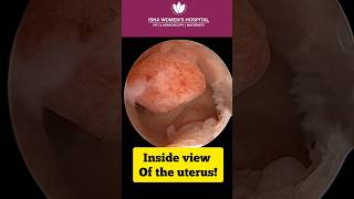 Hysteroscopic polyp removal surgery live  DrChinmay Pataki  Isha Women’s Hospital [upl. by Gusty]