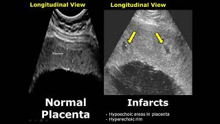 Placenta Ultrasound Normal Vs Abnormal Image Appearances Comparison  Placental Pathologies on USG [upl. by Demetra]