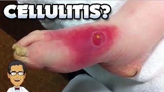 Pimple Staph Infection Diabetic Cellulitis or Blackhead [upl. by Anitsrik876]