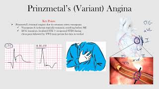 Prinzmetals Angina [upl. by Kohsa]