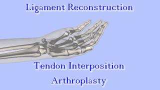 The Anchovy Procedure for Thumb Basal Joint Arthritis [upl. by Jojo]