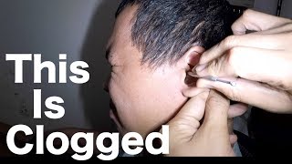 Mans Impacted Earwax Removed without Applying Earwax Softener [upl. by Lowis293]