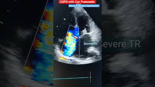 Severe TR Tricuspid Regurgitation Echo l echo heart shorts [upl. by Ahsiled]