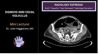 SIGMOID AND CECAL VOLVULUS Mini Lecture Dr John Haggstrom MD [upl. by Urbanna]