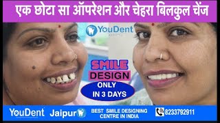 teeth gaps treatment dentist for teeth gaps teeth gaps feeling teeth gaps after braces youdent [upl. by Lauzon]