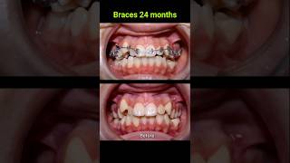 Braces correct all cases of crooked teeth braces orthodontist bracket [upl. by Huber]