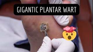 GIGANTIC Wart Removal Verruca Needling [upl. by Ingeberg]