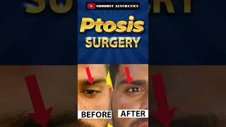 Ptosis Surgery Before And After At Shobhit Aesthetics [upl. by Uticas]