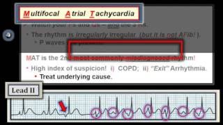 ECG Video6 Blog 100 Rhythm MgmtPart 3 111212014 [upl. by Sutniuq618]