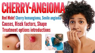 Cherry angioma causes Shapes and treatment options  Red Mole Cherry Hemangioma  Mole Removal [upl. by Eifos]