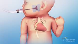 Hypoplastic Left Heart Syndrome HLHS Hybrid Stage One Procedure [upl. by Nodnnarb217]